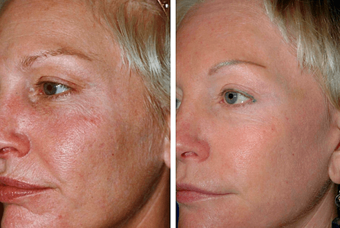 przed i po frakcyjnym odmładzaniu skóry fot. 1