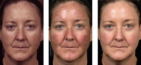 przed i po frakcyjnym odmładzaniu skóry fot. 2