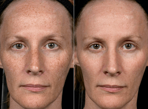 przed i po frakcyjnym odmładzaniu skóry fot. 3