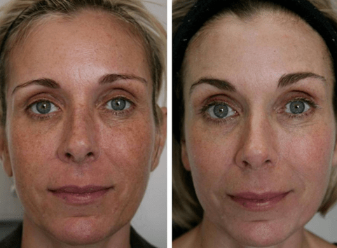 przed i po frakcyjnym odmładzaniu skóry fot. 4