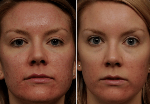 przed i po frakcyjnym odmładzaniu skóry fot. 6