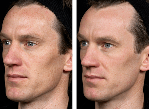 przed i po frakcyjnym odmładzaniu skóry zdjęcie 5