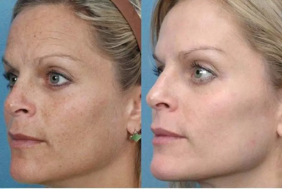 przed i po sprzętowym odmładzaniu skóry zdjęcie 1