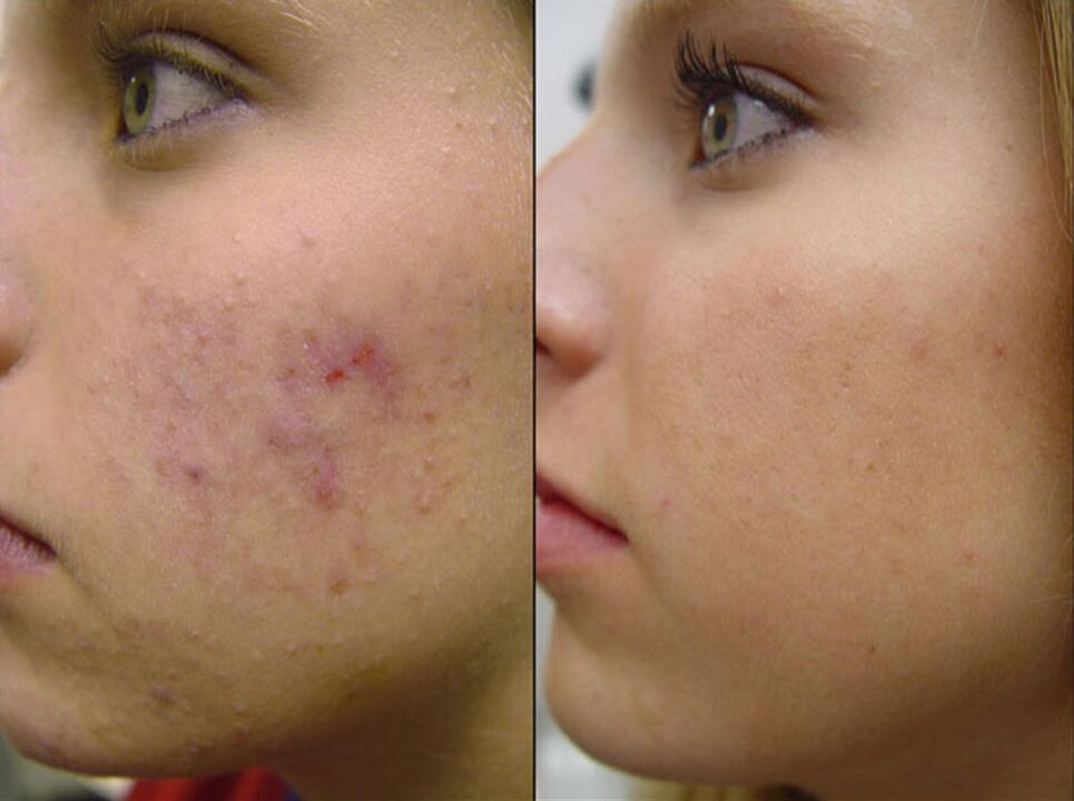 przed i po sprzętowym odmładzaniu skóry zdjęcie 2