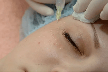Mezoterapia