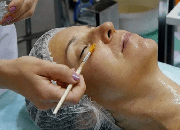 Peeling chemiczny