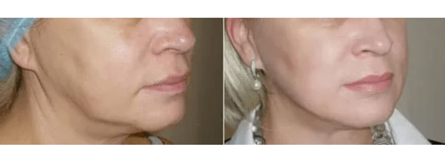 regeneracja po odmłodzeniu skóry