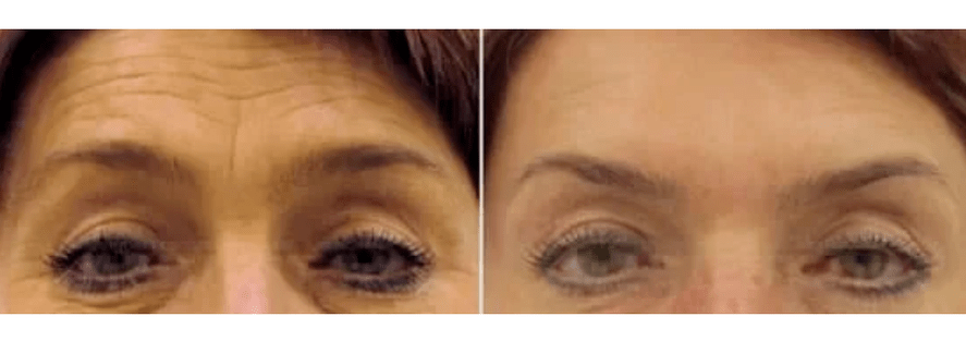 urządzenia do frakcyjnego odmładzania